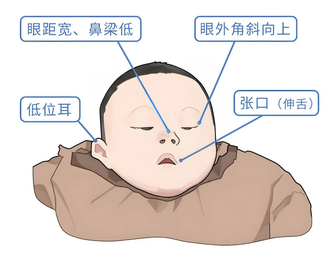 唐氏儿为何长相相似？21号染色体揭示惊人遗传真相